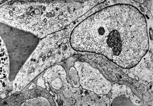 F,49y. | hemangioblastoma - brain